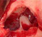 Fig 8. Unusually large maxillary septum found in the right maxillary sinus (photograph courtesy of Yelena Shapiro, DDS).