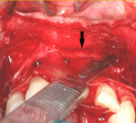 Fig 9. Periosteal fenestration is performed in the maxillary anterior segment using the bevel of the blade to sever the periosteum.