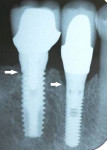Fig 11. The implant at site No. 29 is a bone-level implant, which develops a subcrestal biologic width and manifests bone loss. At site No. 30, there is a tissue-level implant with a polished collar that forms a supracrestal biologic width and it is associated with minor bone loss.
