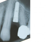 Fig 13. Maxillary canine at site No. 11 has an 11-degree distal tilt. Implants placed in the first bicuspid area, site No. 12, need to be placed parallel to the canine.