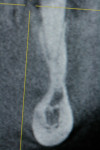 Fig 5. Hourglass mandible at site No. 20 is an uncommon finding and can only be detected on a CBCT scan.