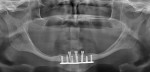 Fig 7. Panoramic radiograph taken immediately postoperative showing the position of the implants and legacy LOCATOR abutments.