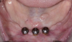 Fig 9. Denture attachment housings placed on the abutments.