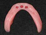 Fig 10. Intaglio surface of the existing mandibular denture after laboratory reline and intraoral pick-up of LOCATOR housings, which thus converted the prosthesis into a mandibular implant-retained overdenture with the three red extended-range inserts visible.