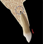 Fig 27. Completion of initial phase of eruption resulted in thinning of alveolar bone both palatally and facially with concomitant apposition of bone apically (blue dotted circle).