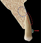 Fig 28. Further eruption with a more apical position of the bracket driving the root facially, resulting in loss of entire facial bone (red dotted circle) with more apical apposition
(blue dotted circle).