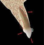 Fig 26. Initial phase of eruption comprises
both facial and palatal compressive forces due
to A-P discrepancy, resulting in bone resorption (red dotted circles).