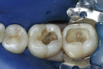 Figure 2  A rubber dam and a matrix were placed before removing the amalgam restorations and secondary caries and before etching and adhesive bonding.