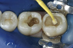 Figure 4  A single-component total-etch adhesive (ExciTE) was placed on the preparations of teeth Nos. 30 and 31.