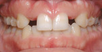Figure 16d  Comparison of frontal intraoral views at pretreatment, end of treatment,initiation of fixed treatment to parallel roots, and posttreatment. Clear alignertreatment was repeated for 6 months to finish treatment because patient wantedfixed a