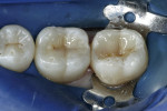 Figure 8  Bleach Incisal shade (Tetric EvoCeram) was used to build the triangular ridges and overlay the A3 dentin build-up.