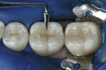 Figure 9: Using a P1 carver, the cusps were built-up further and cured.