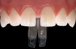 Figure 1  The thin (58 µm) Bioclear diastema closure matrices are remarkably strong and allow porcelain-like contours and finishes. Until now, the traditional flat Mylar strip matrices have severely limited composite restoration possibilities.