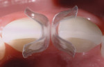 Figure 2  Incisal view of the dedicated mesial (DC-201) Bioclear diastema closure matrix. Note the broad buccal–lingual contact area that allows for a strong and wide contact.