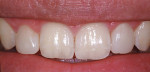 Figure 4  Two-week postoperative view after treatment with direct composite and the Bioclear Matrix System. A reasonable color match was achieved with a single shade of composite, Filtek ™ Supreme Ultra B-1 Body shade.