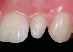 Figure 5  High-magnification preoperative view of tooth No. 10. Note the beautiful tissue health with perfect stippling and salmon pink color. Rarely does the tissue look this pristine next to a peri-gingival porcelain margin when viewed at high magn