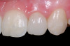 Figure 2  Case One Pretreatment clinical view, Case 1, maxillary anterior.