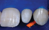 Figure 5  Case One Root preparation of teeth Nos. 9 through 11.