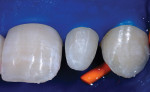 Figure 9: A heavy latex rubber dam provides two important functions; first to retract and protect the papillae, and second to help press the matrices against the tooth to seal the gingival margin and to stabilize the Bioclear Matrix.