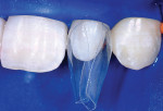 Figure 10  Two Bioclear diastema closure matrices (Bioclear DC-204) that are specific for diastema closure of smaller incisors are inserted inciso-gingivally.