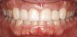 Figure 18  Postrestorative treatment. Teeth Nos. 7 and 10have crowns over the implants. The centrals and canineswere also veneered for better control of crown-form sizematching and color with implant crowns. Gingival healthremained excellent througho