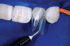 Figure 10  Case One The 2.5-week postoperative view, maxillary anterior.
