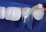 Figure 16  Facial and palatal views of the Stage II wedging technique. The remainder of the restoration is then placed in a single injection mold step. Exotic layering with multiple shades and opacities of composite is a luxury that is less critical