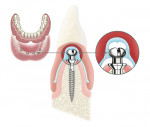 Figure 1  The retention, stabilization, and cushioning effect of Atlas Denture Comfort implants for a mandibular denture. Photograph courtesy of DMX Implants, a Dentatus Division.