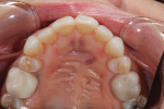 Fig 1. This occlusal view shows the lingually positioned tooth No. 5.