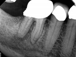 Preoperative radiograph of tooth No. 30, which was treated using a two-visit approach with calcium hydroxide as an intracanal medicament.