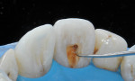 The inside of an endodontically-treated tooth must be opened sufficiently to remove pulp debris and any material that is causing discoloration.