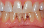 Three months of nightly bleaching using 10% carbamide peroxide in a custom-fitted,
non-scalloped, no-reservoir tray successfully removed the nicotine staining. Figures 1, 4, and 5 were previously published in Haywood, VB. Tooth Whitening: Indications and outcomes of
Nightguard Vital Bleaching. Chicago, IL: Quintessence; 2007 and reproduced with permission.