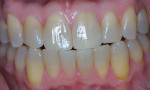 Tetracycline staining occurs deep in the dentin and is the most difficult stain to remove. Figures 6 and 7 were previously published in Haywood, VB. Tooth Whitening: Indications and outcomes of Nightguard Vital Bleaching. Chicago, IL: Quintessence; 2007 and reproduced with permission.