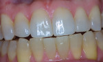 Tetracycline-stained teeth after 7 months of nightly bleaching treatment with 10% carbamide peroxide in a non-scalloped, no-reservoir, custom tray. Figures 6 and 7 were
previously published in Haywood, VB. Tooth Whitening: Indications and outcomes of Nightguard Vital Bleaching. Chicago, IL: Quintessence; 2007 and reproduced with permission.