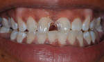 A patient with extensive decay that elicits concerns regarding pulpal involvement as well as the restorability of the tooth needs some type of protective restoration prior to the initiation of bleaching.