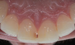 After bleaching over minimal decay, the proper shade can be selected, and the tooth can be restored.