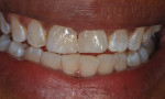 The caries is removed, and a protective
restoration is placed to allow for further bleaching without concern for the advancement of decay if the patient stops bleaching.