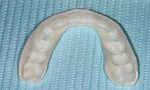 An example of a thermoplastic tray that
can be softened with hot water and formed
directly in the mouth without making an alginate impression and cast.