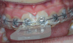 Thermoplastic tray fabricated directly in the mouth and over the braces with no need to remove the arch wires.