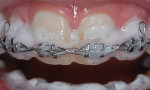 Gly-Oxide, which has a bubbling, foaming action, is injected into the brackets as an adjunct to oral hygiene procedures.