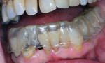 Custom tray used with 10% carbamide peroxide and worn nightly for caries control in
elderly patients.