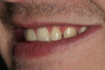 Figure 3  A left side view of the patient’s smile.