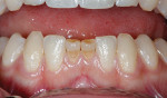 Fig 1. Primary teeth with no permanent incisor replacements. The space would be too wide to replace both primary teeth with a
single restoration and too narrow to accommodate two implants.