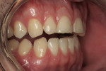 Figure 5  A preoperative retracted view of the right side of the patient’s dentition.