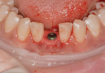 Fig 4. Properly aligned implant (implant placement by periodontist David Barack, DDS).