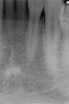 Fig 2. Initial radiograph showing congenitally missing permanent lower incisors.