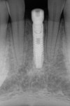 Fig 5. Properly aligned implant (implant placement by periodontist David Barack, DDS).