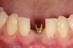 Fig 7. Abutment was tried in the mouth for verification.