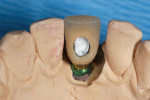 Fig 8. Crown was seated on the CAD/CAM abutment on a stone model with screw-access
hole covered prior to final cementation.