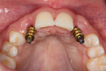 Fig 11. Implant placement was ideal for delivering a final screw-retained restoration.